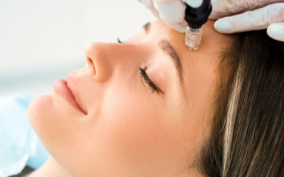 Skin Needling